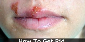 How to Get Rid of Cold Sore Fast