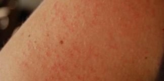 Prickly Heat Remedies For Treatment at Home