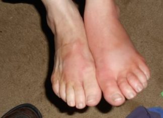 Swollen Feet Remedies for Treatment at Home