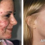 Home Remedies for Acne Get Rid of Acne Naturally