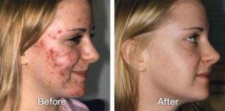 Home Remedies for Acne Get Rid of Acne Naturally