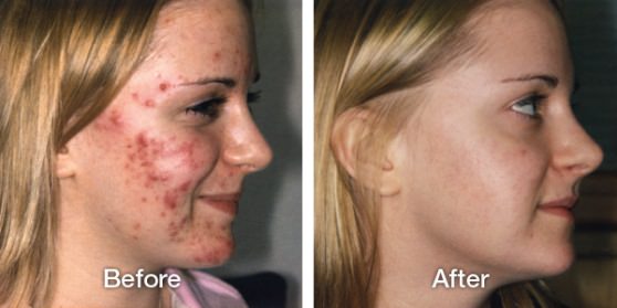 Home Remedies For Acne Get Rid Of Acne Naturally