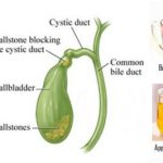 Home Remedies for Gallstones Treatment