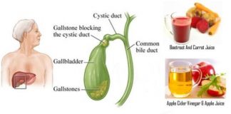 Home Remedies for Gallstones Treatment