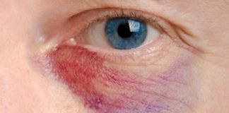 Home Remedies to Get Rid of Black Eye Fast Naturally