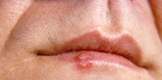 Home Remedies to Get Rid of Fever Blisters Naturally