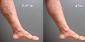 Home Remedies to Get Rid of Spider Veins Naturally