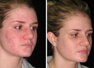 How to Get Rid of Acne Naturally Home Remedies