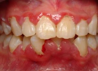 How to Reduce Gum Swelling Quickly
