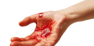 How to Stop Bleeding From Cuts and Internal Bleeding