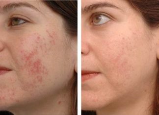 Home Remedies for Acne Scars Get Rid of Acne Scars