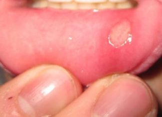 Home Remedies to Get Rid of Canker Sores
