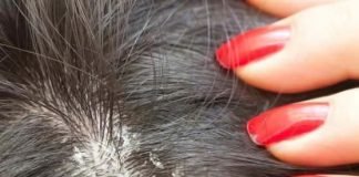 How to Get Rid of Dandruff at Home Home Remedies for Dandruff