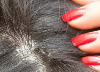 How to Get Rid of Dandruff at Home Home Remedies for Dandruff