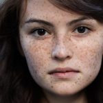 How to Get Rid of Freckles Naturally and Fast