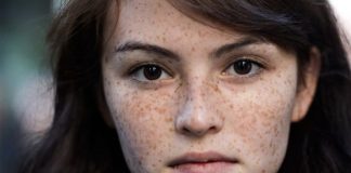 How to Get Rid of Freckles Naturally and Fast