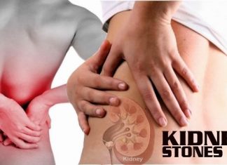 How to Get Rid of Kidney Stones Prevent Kidney Stones
