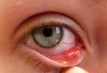 Home Remedies for Pink Eye Treatment Get Rid of Pink Eye