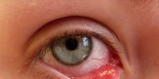 Home Remedies for Pink Eye Treatment Get Rid of Pink Eye