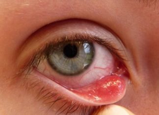 Home Remedies for Pink Eye Treatment Get Rid of Pink Eye