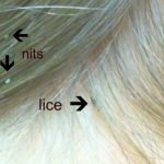 How to Get Rid of Lice Lice Treatment at Home