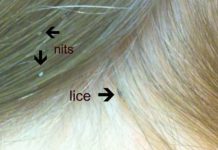 How to Get Rid of Lice Lice Treatment at Home