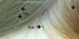 How to Get Rid of Lice Lice Treatment at Home