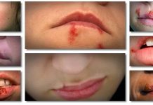 Natural Cold Sore Remedies to Get Rid of Cold Sores