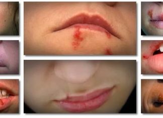 Natural Cold Sore Remedies to Get Rid of Cold Sores