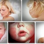 Natural Eczema Treatment to Get Rid of Eczema at Home