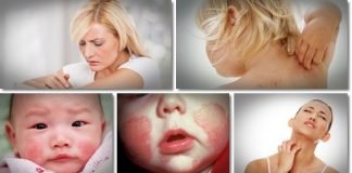 Natural Eczema Treatment to Get Rid of Eczema at Home
