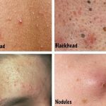 Acne and Acne Types