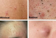 Acne and Acne Types