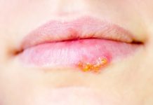 How to Get Rid of Cold Sores Cold Sore Remedies