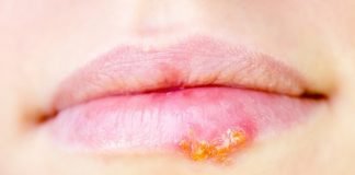 How to Get Rid of Cold Sores Cold Sore Remedies
