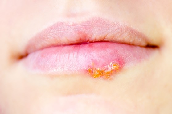 can you get cold sores from shingles
