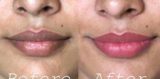 Home Remedies to Get Rid of Dark Lips Naturally
