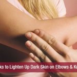 How Get Rid Of Black Knees And Elbows