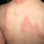 How to Treat Hives Naturally
