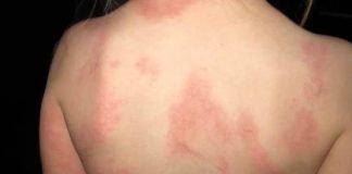 How to Treat Hives Naturally