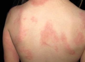 How to Treat Hives Naturally