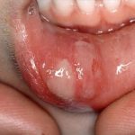 How to Treat Ulcers