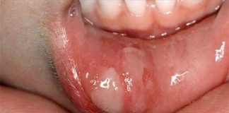 How to Treat Ulcers