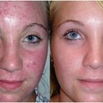How to Fade Acne Scars Including Home Remedies