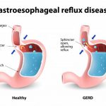 https://lethow.com/wb-content/uploads/2015/08/Home-Remedies-For-Gastro-Esophageal-Reflux-Disease-GERD.jpg