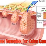 Home Remedies To Prevent Colon Cancer