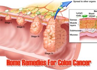 Home Remedies To Prevent Colon Cancer