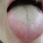 Home Remedies for White Tongue Treatment
