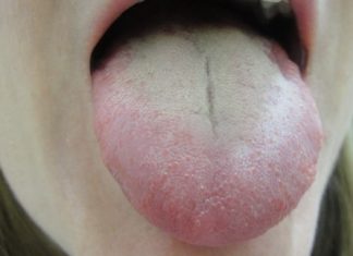 Home Remedies for White Tongue Treatment