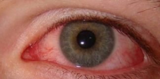 How do You Get Pink Eye